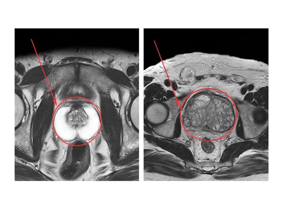 Vergleich zwischen einer gesunden (links) und einer entzündeten (rechts) Prostata auf MRT-Bildern